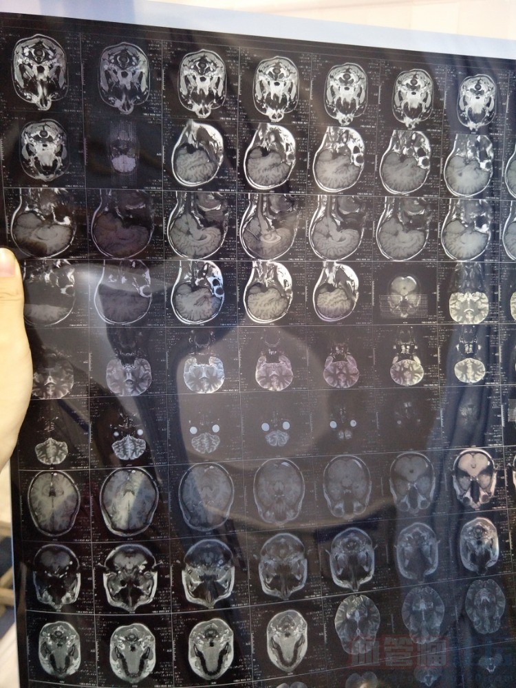 脸部血管瘤的核磁共振拍片，做义诊的话要做几个疗程？_血管瘤论坛-中国血管瘤患者之家