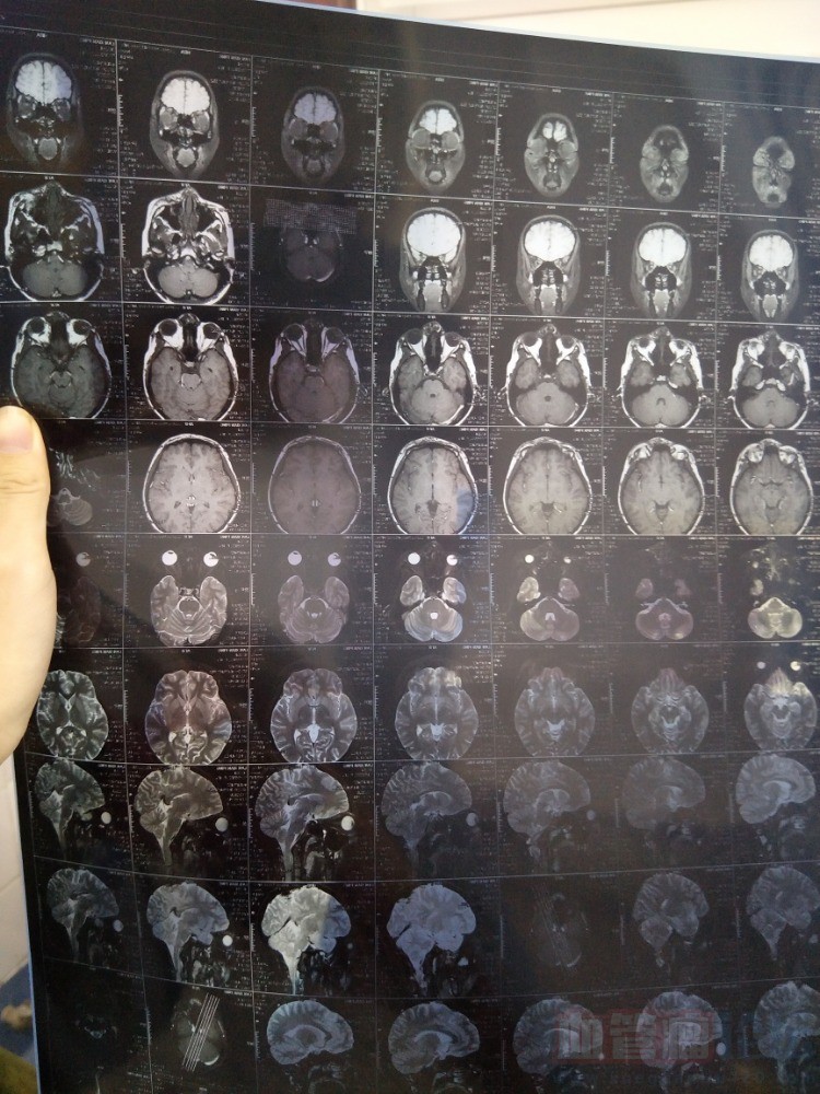 脸部血管瘤的核磁共振拍片，做义诊的话要做几个疗程？_血管瘤论坛-中国血管瘤患者之家