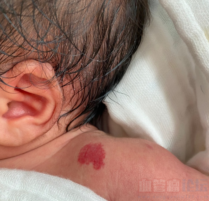 宝宝身上长了血管瘤_血管瘤论坛-中国血管瘤患者之家