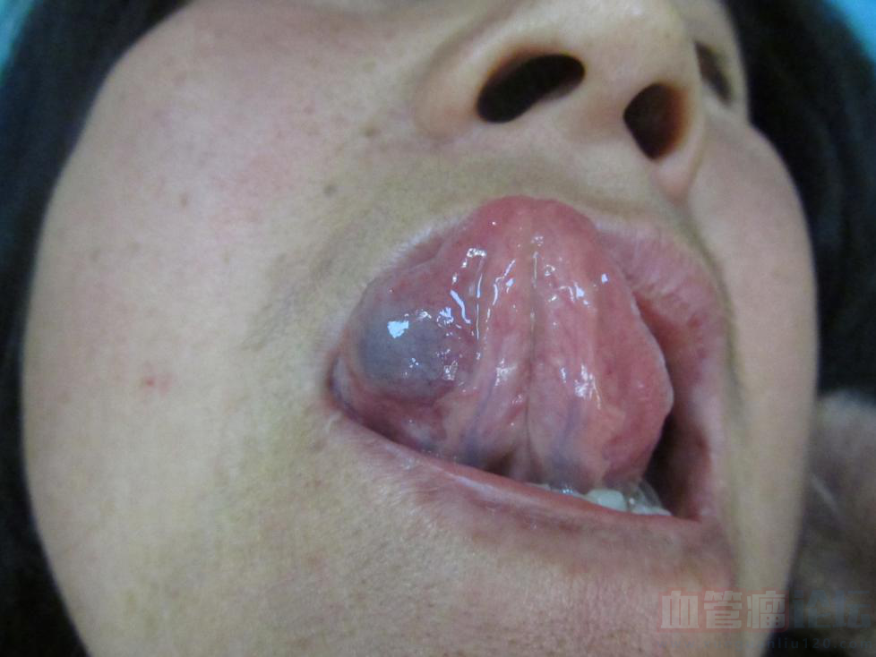 舌头痛去医院检查说是舌头血管瘤，治疗方法的是什么？_血管瘤论坛-中国血管瘤患者之家