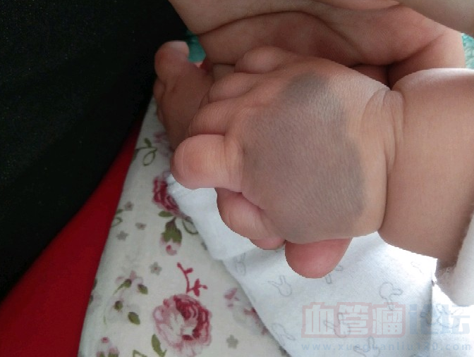 胳膊上血管瘤 手上有胎记 二胎真的太难了_血管瘤论坛-中国血管瘤患者之家