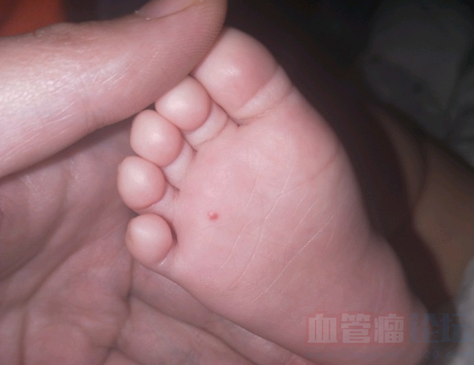 大家帮忙看下这是血管瘤吗要怎么治疗，宝宝四个月_血管瘤论坛-中国血管瘤患者之家