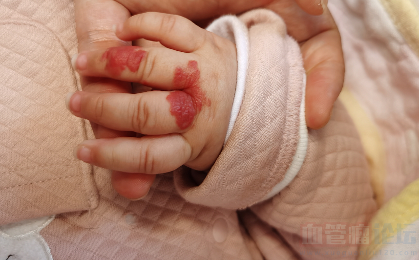 宝宝出生两三天开始发现手部有血管瘤_血管瘤论坛-中国血管瘤患者之家