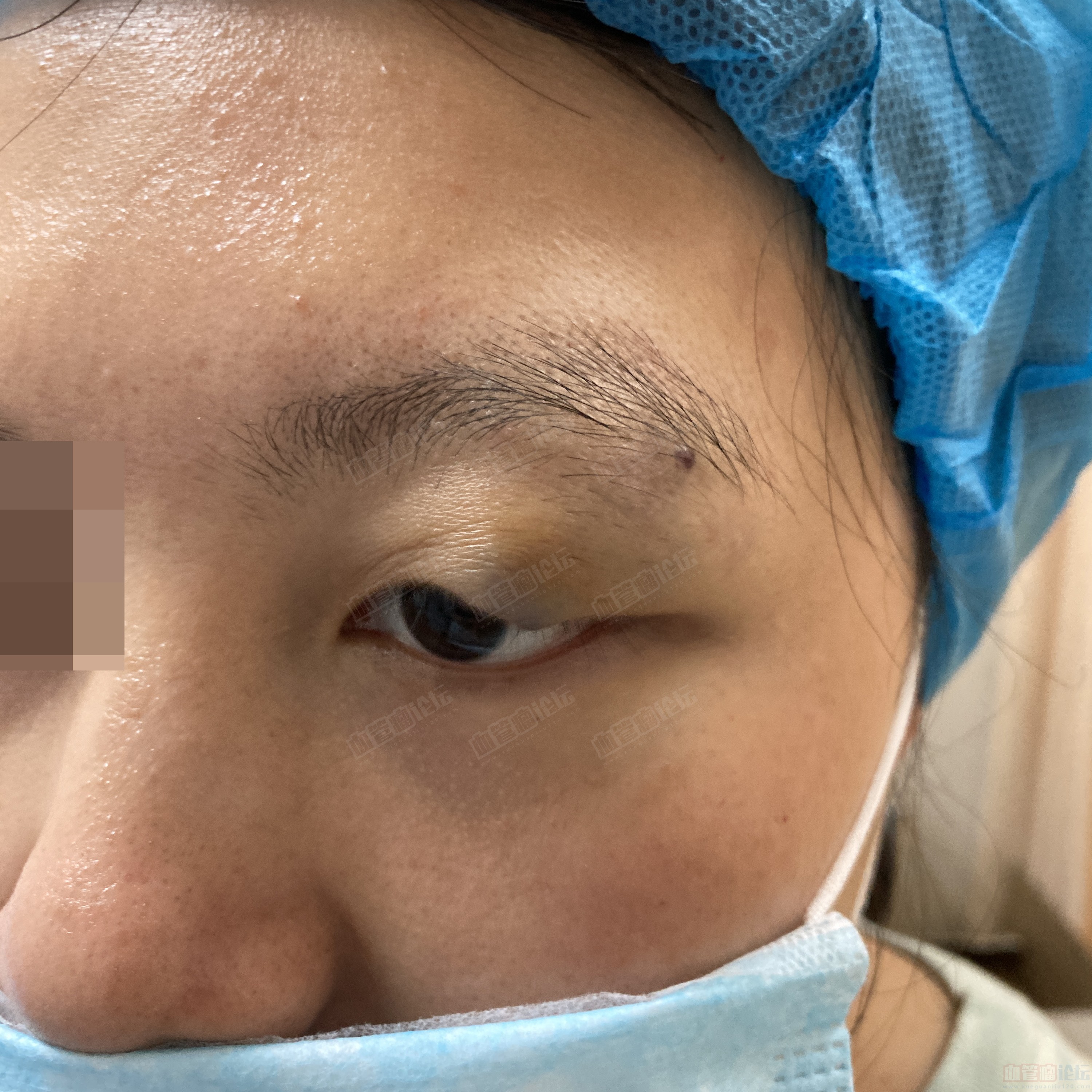 【义诊患友治疗追踪】上眼睑静脉畸形（更新至10月）_血管瘤论坛-中国血管瘤患者之家