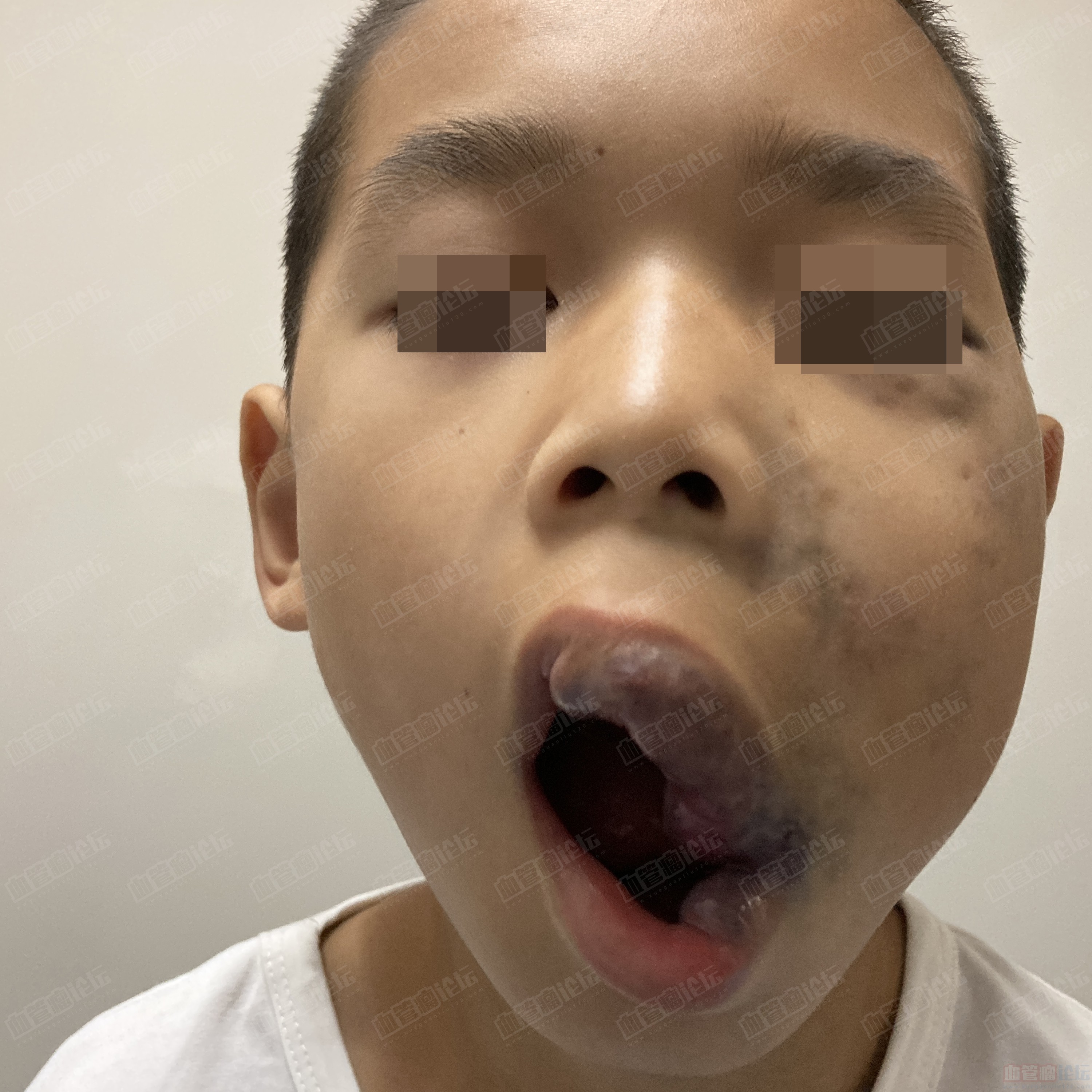 【义诊患友治疗追踪】10岁男孩面部血管畸形（更新到11月）_血管瘤论坛-中国血管瘤患者之家