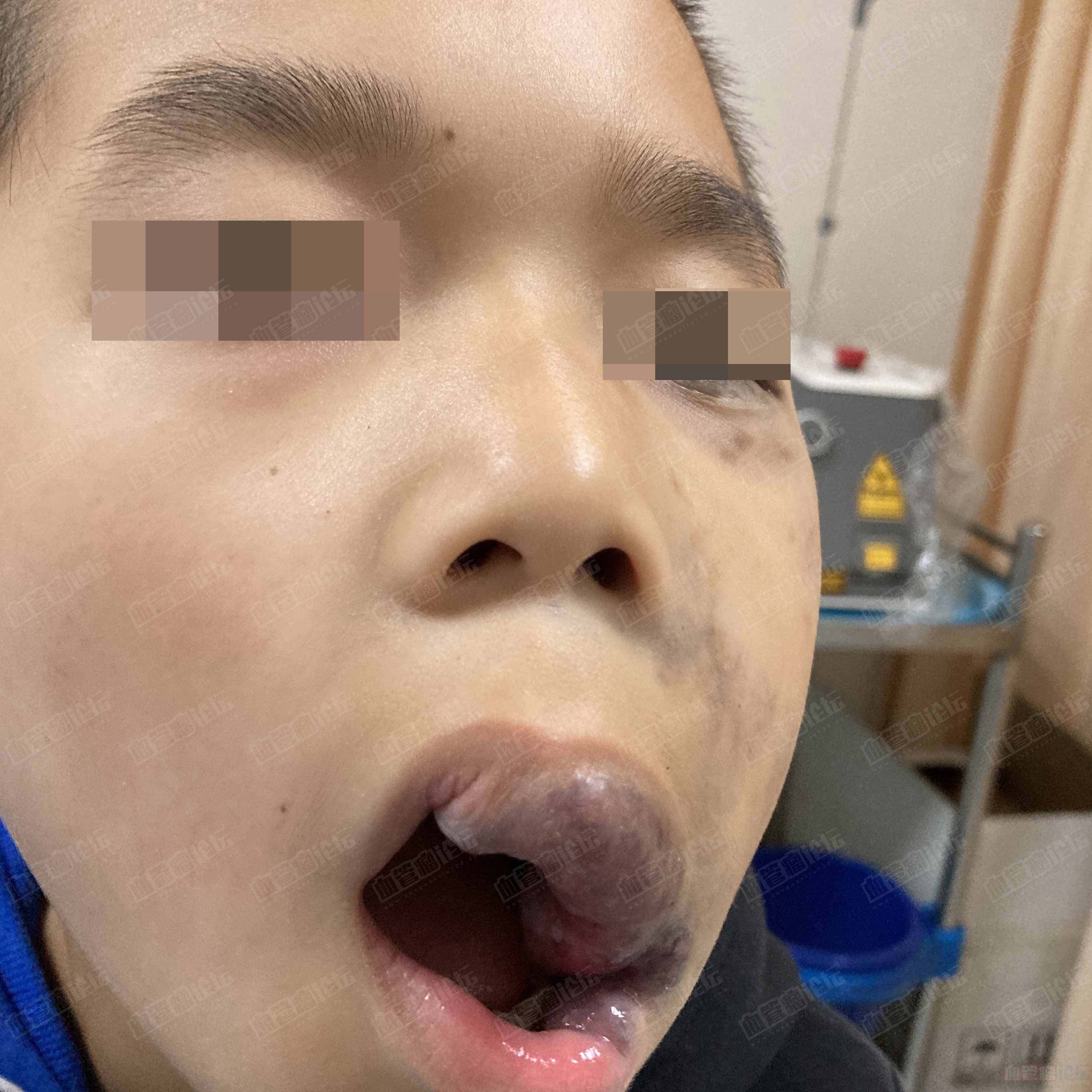 【义诊患友治疗追踪】10岁男孩面部血管畸形（更新到11月）_血管瘤论坛-中国血管瘤患者之家