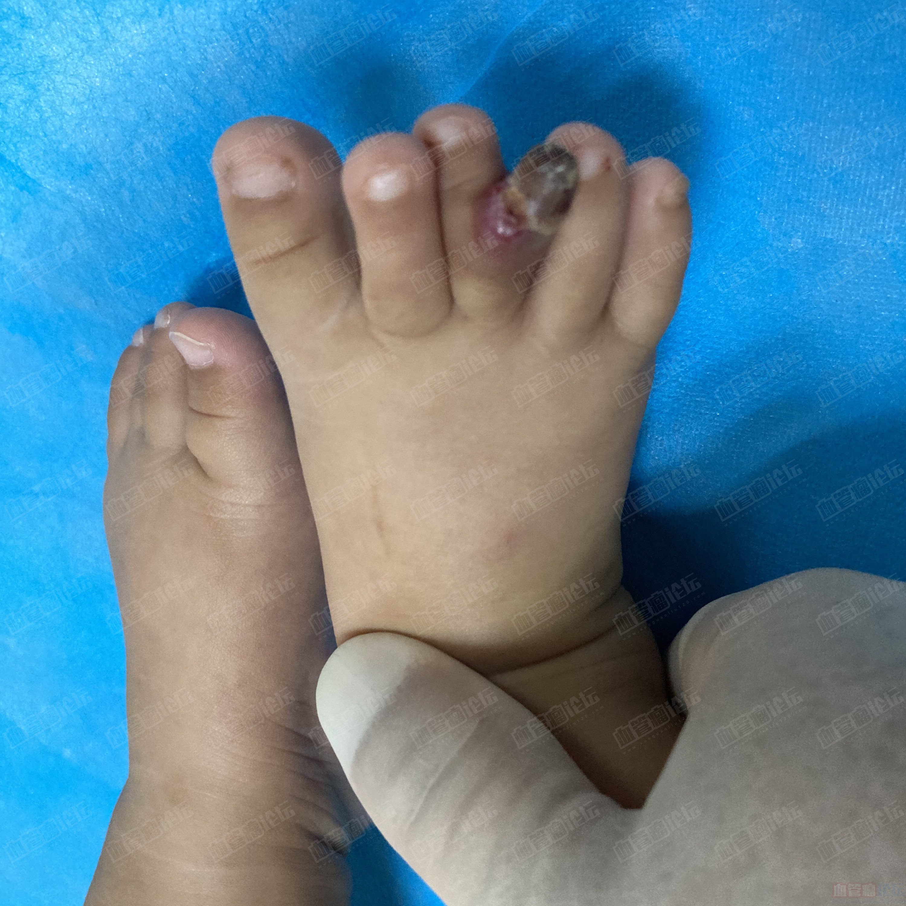 义诊患友治疗追踪宝宝脚趾血管瘤已随访观察
