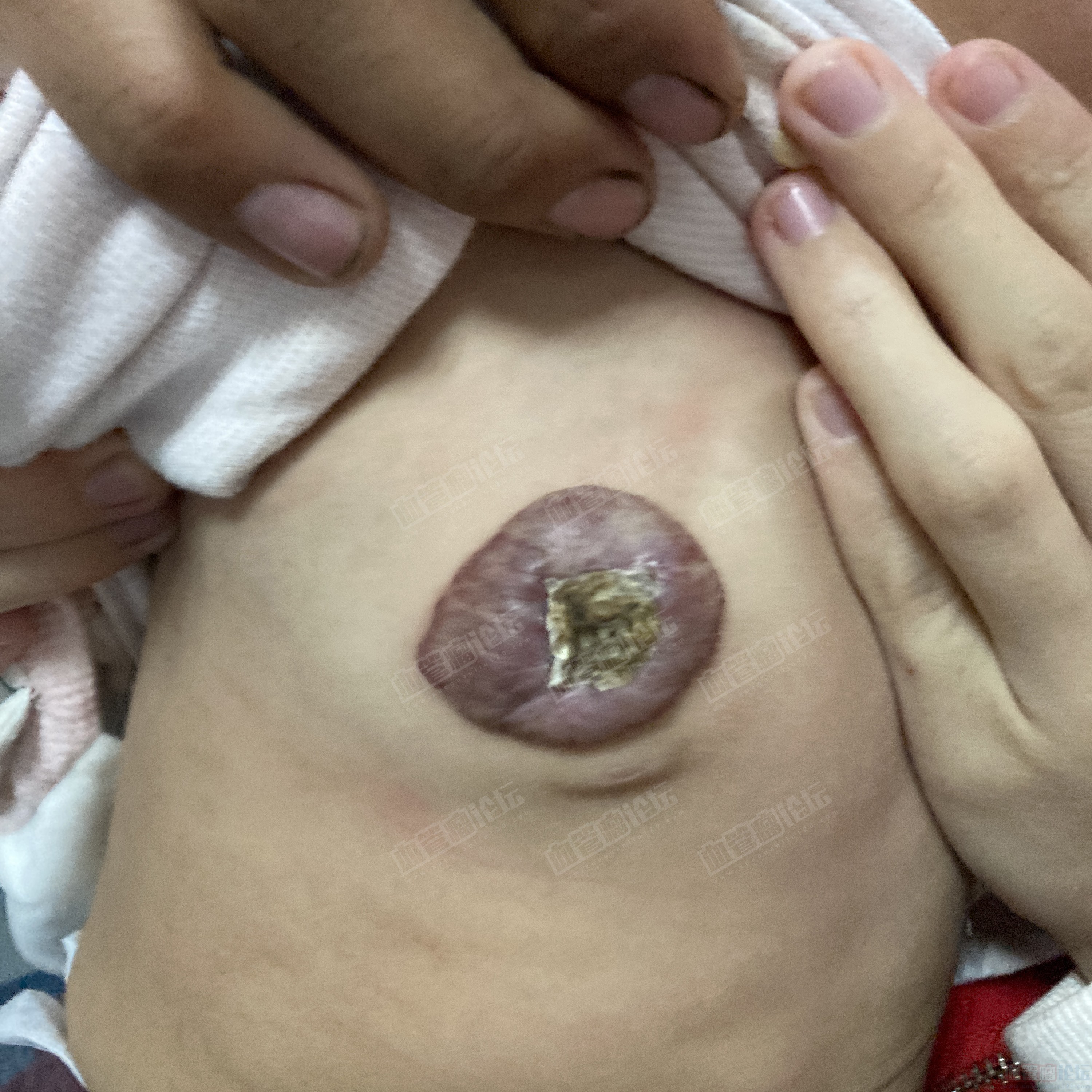 【义诊患友治疗追踪】女宝胸部复合型血管瘤（更新到10月）_血管瘤论坛-中国血管瘤患者之家