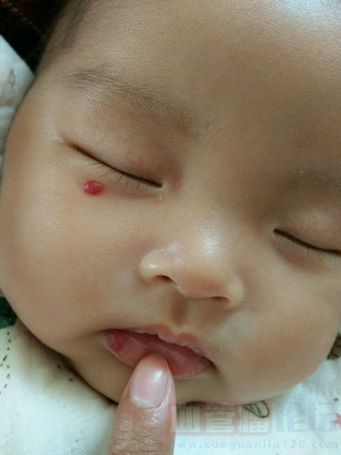 宝宝眼睛下面和嘴巴那里各有一个血管瘤_血管瘤论坛-中国血管瘤患者之家