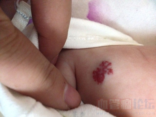 宝妈们请问宝宝胳膊上是血管瘤吗_血管瘤论坛-中国血管瘤患者之家