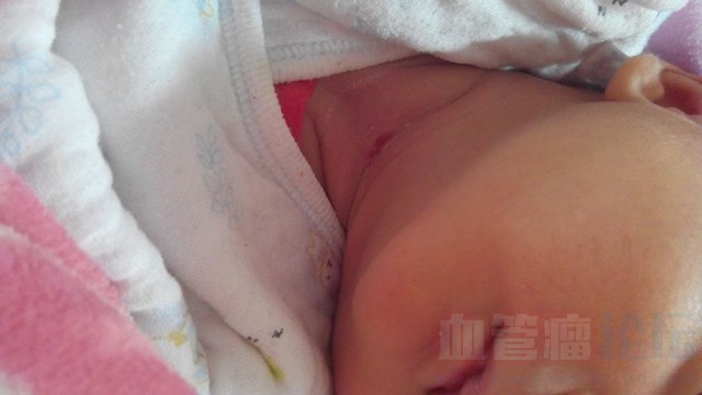 新生儿血管瘤严重吗？有没有宝宝有血管瘤的宝妈，好了吗_血管瘤论坛-中国血管瘤患者之家