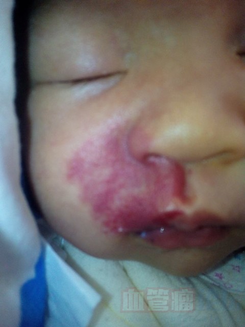 我家宝宝血管瘤长在脸上的，好担心女宝宝怎么办啊？_血管瘤论坛-中国血管瘤患者之家
