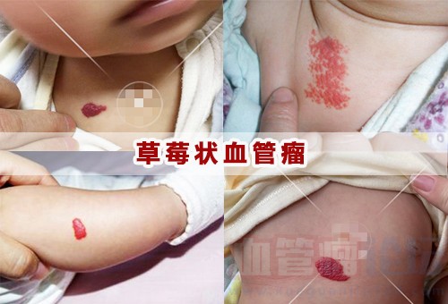 如何初步判断草莓状血管瘤_血管瘤论坛-中国血管瘤患者之家