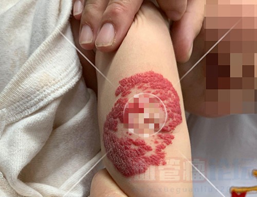 治疗草莓状血管瘤要避免这些坑_血管瘤论坛-中国血管瘤患者之家