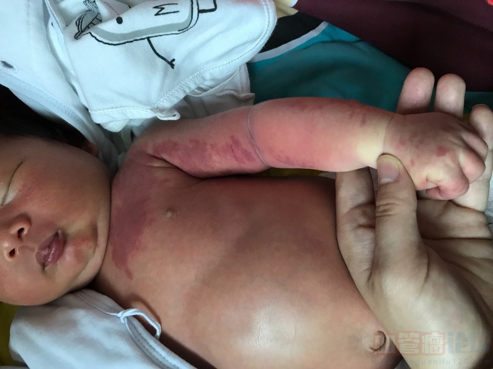 宝宝大片红斑，能治好吗_血管瘤论坛-中国血管瘤患者之家