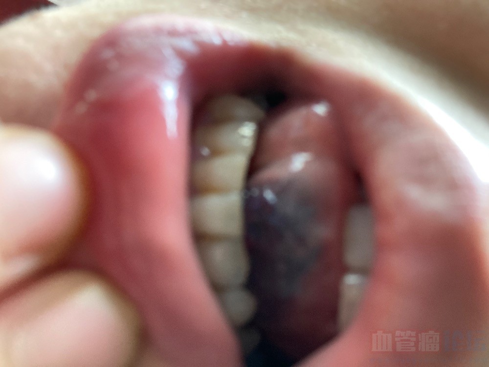舌下血管瘤的产妇快抑郁了_血管瘤论坛-中国血管瘤患者之家