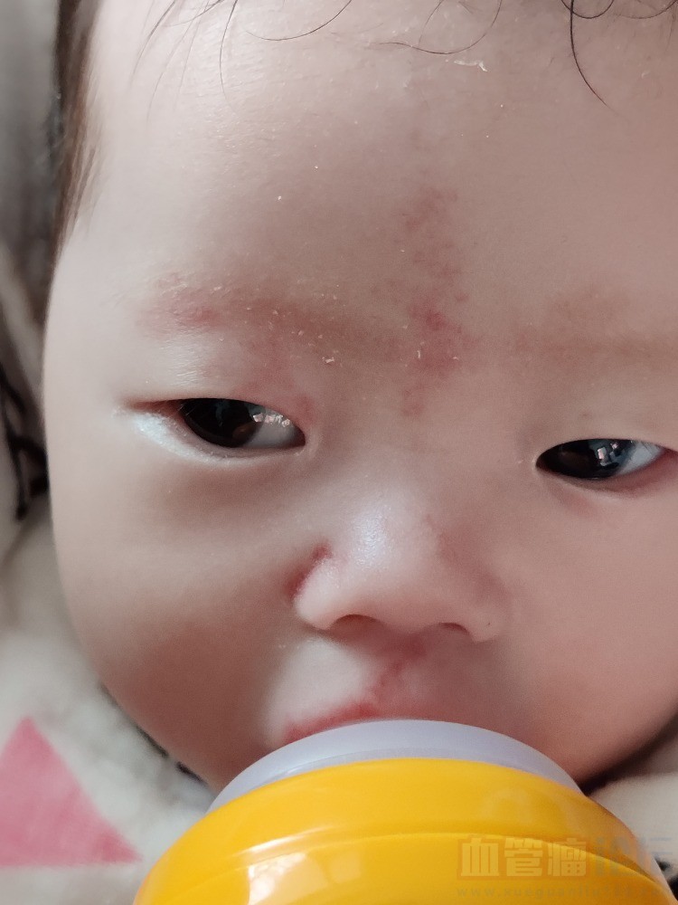 新生儿鲜红斑痣_血管瘤论坛-中国血管瘤患者之家