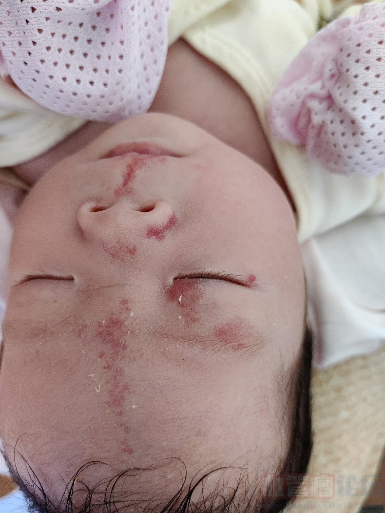 新生儿鲜红斑痣_血管瘤论坛-中国血管瘤患者之家