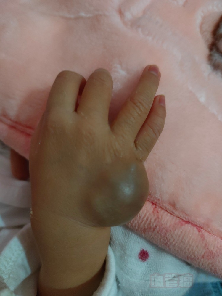 婴儿手背肉囊咨询_血管瘤论坛-中国血管瘤患者之家