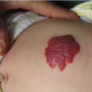 宝宝身上长了小红点是血管瘤吗？都有哪些危害_血管瘤论坛-中国血管瘤患者之家