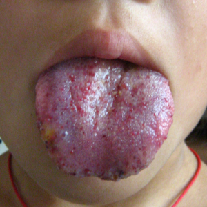 发生舌头血管瘤应该如何护理？_血管瘤论坛-中国血管瘤患者之家