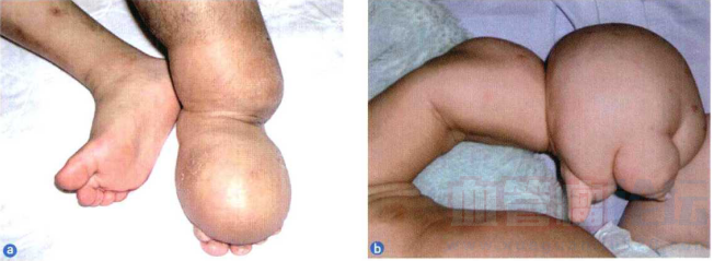 下肢淋巴管瘤图片图片