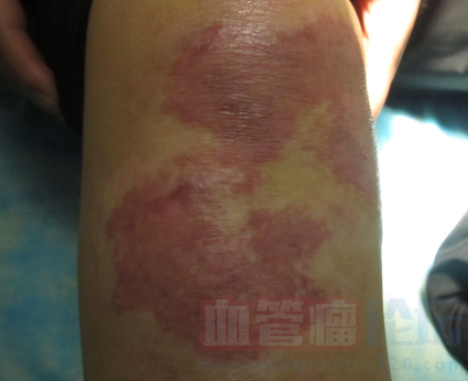 鲜红斑痣多发于哪些部位？_血管瘤论坛-中国血管瘤患者之家