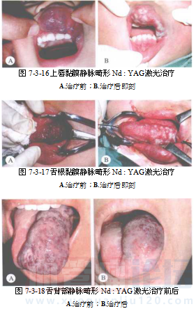 静脉畸形的治疗_血管瘤论坛-中国血管瘤患者之家