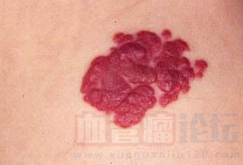 草莓状血管瘤的危害和饮食注意_血管瘤论坛-中国血管瘤患者之家