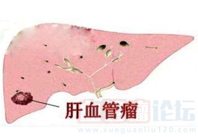 肝血管瘤的危害有什么？_血管瘤论坛-中国血管瘤患者之家