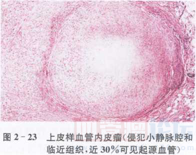 上皮样血管内皮瘤_血管瘤论坛-中国血管瘤患者之家
