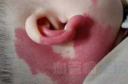 什么是耳部血管瘤？_血管瘤论坛-中国血管瘤患者之家