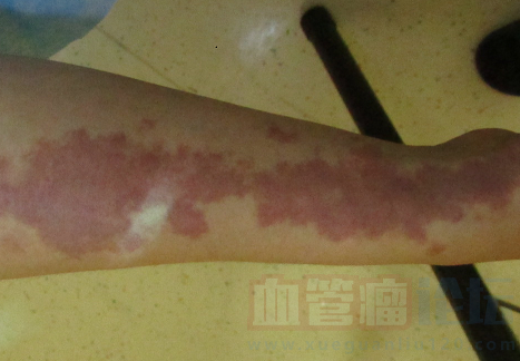 鲜红斑痣的类型有哪些？_血管瘤论坛-中国血管瘤患者之家
