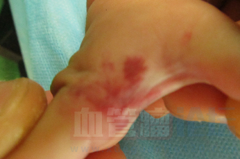 孩子的手部草莓状血管瘤为什么老是出血？_血管瘤论坛-中国血管瘤患者之家