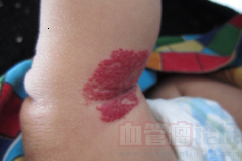 草莓状血管瘤对孩子的危害_血管瘤论坛-中国血管瘤患者之家