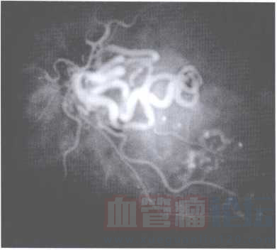 视网膜蔓状血管瘤_血管瘤论坛-中国血管瘤患者之家