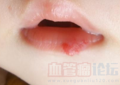 婴儿嘴唇血管瘤图片