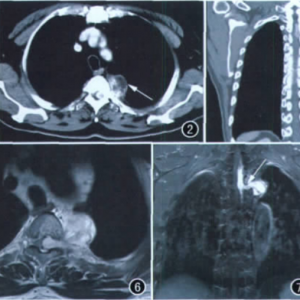 椎管及后纵隔海绵状血管瘤的CT和MRI表现_血管瘤论坛-中国血管瘤患者之家
