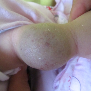 宝宝脸上长了“红斑”如何判断是不是血管瘤_血管瘤论坛-中国血管瘤患者之家