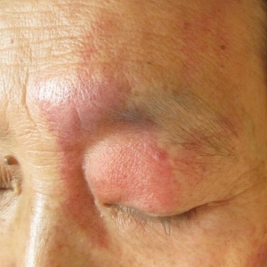 面颈部鲜红斑痣的治疗_血管瘤论坛-中国血管瘤患者之家