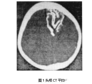 新生儿脑面血管瘤病一例_血管瘤论坛-中国血管瘤患者之家
