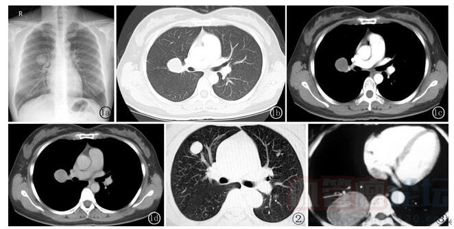 肺硬化性血管瘤的CT表現_血管瘤論壇-中國血管瘤患者之家
