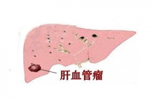 常见的几种血管瘤的早期症状_血管瘤论坛-中国血管瘤患者之家