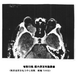 眶内原发性脑膜瘤误诊为海绵状血管瘤1例_血管瘤论坛-中国血管瘤患者之家