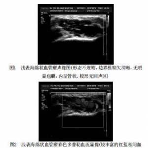 浅表海绵状血管瘤的超声诊断与病理对照分析_血管瘤论坛-中国血管瘤患者之家