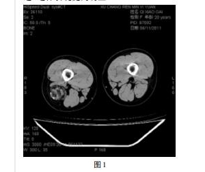 软组织血管瘤20例CT分析_血管瘤论坛-中国血管瘤患者之家