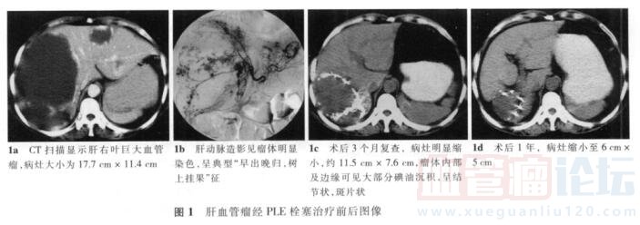 平陽霉素碘油乳劑動脈栓塞治療肝血管瘤的中遠期療效評價_血管瘤論壇-中國血管瘤患者之家