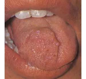 舌部血管瘤的危害有哪些？_血管瘤论坛-中国血管瘤患者之家