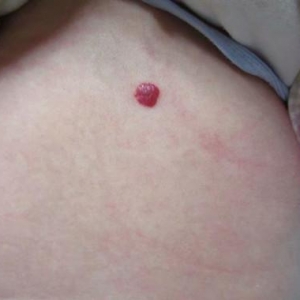 婴儿身上的红色小斑点是血管瘤吗？有哪些危害？_血管瘤论坛-中国血管瘤患者之家