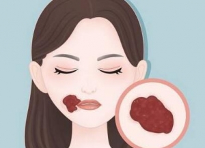 唇部血管瘤的常见类型有哪些？会有什么危害？_血管瘤论坛-中国血管瘤患者之家